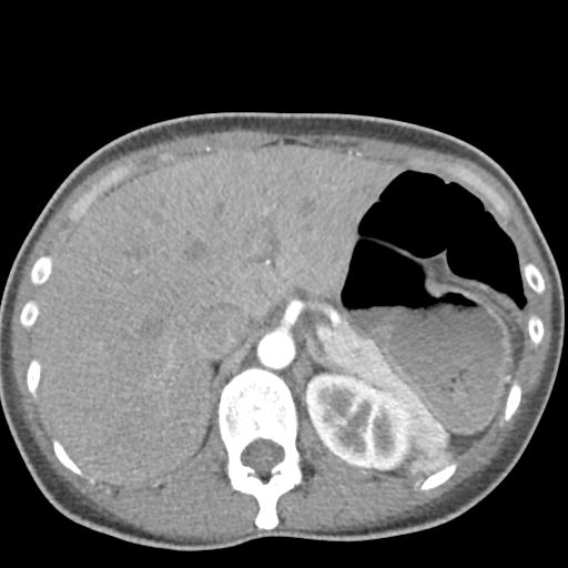 Anterior mediastinal lymphoma (Radiopaedia 29556-30061 C 56).jpg