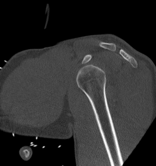 Anterior shoulder dislocation with Hill-Sachs and bony Bankart lesions (Radiopaedia 40424-42974 Sagittal bone window 20).png