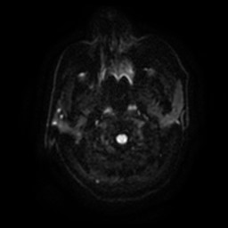 Anterior shoulder fracture dislocation (Radiopaedia 85337-100965 Axial DWI 3).jpg
