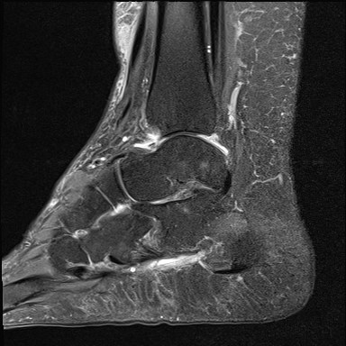 File:Anterior talofibular ligament injury - rupture with soft-tissue impingement (Radiopaedia 38765-40928 Sagittal PD fat sat 8).jpg