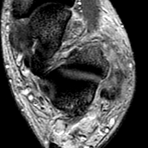File:Anterior talofibular ligament rupture (Radiopaedia 15831-15484 Axial T2* 14).jpg