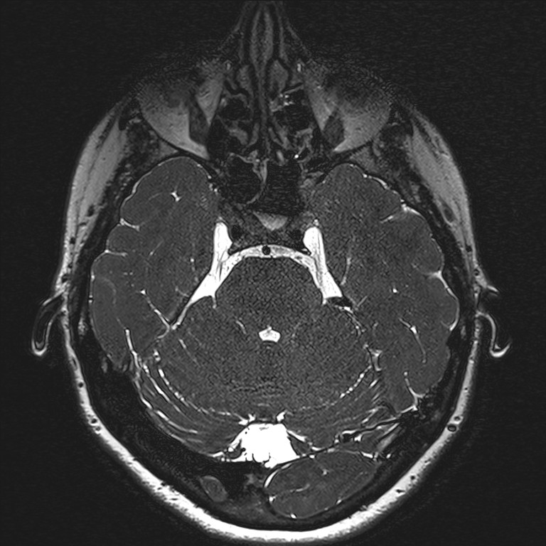 Anterior temporal encephalocele (Radiopaedia 82624-96808 Axial T2 high res 45).jpg
