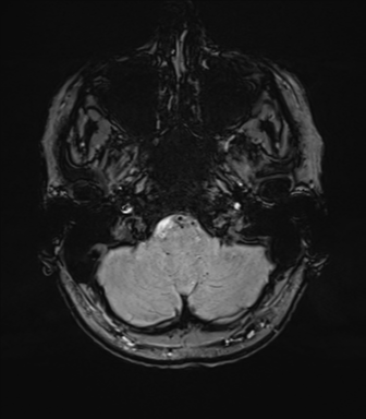 Anterior temporal lobe perivascular space (Radiopaedia 40946-43650 Axial SWI 12).png