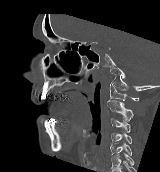 File:Anterior temporomandibular joint dislocation (Radiopaedia 59430-66784 B 25).jpg