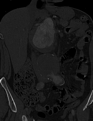 Anterior vertebral scalloping (abdominal aortic aneurysm) (Radiopaedia 66744-76067 Coronal bone window 13).jpg