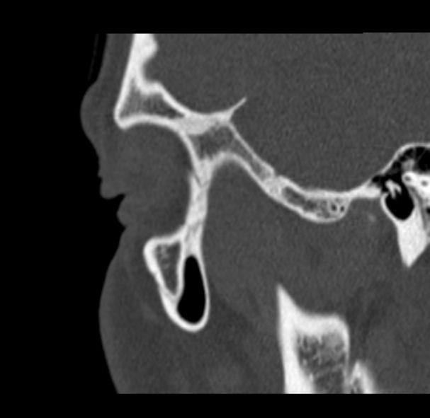 Antrochoanal polyp (Radiopaedia 33984-35202 Sagittal bone window 78).jpg
