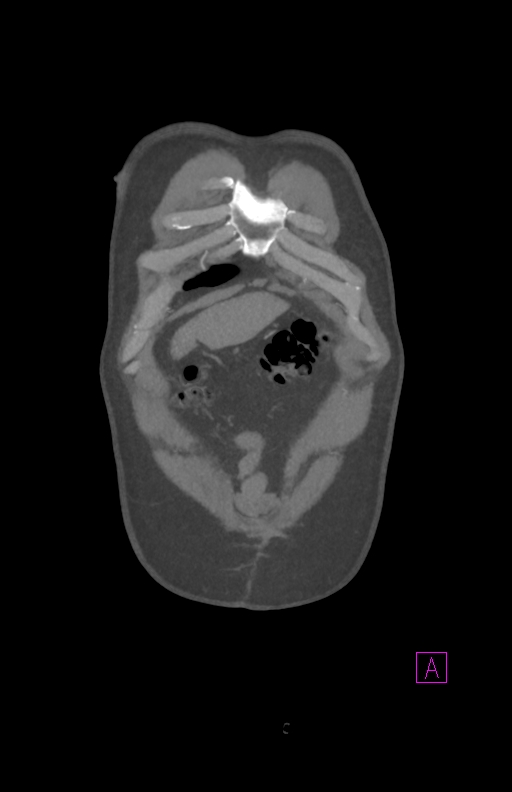 Aortectomy and axillary-bifemoral bypass (Radiopaedia 28303-28545 C 12).jpg