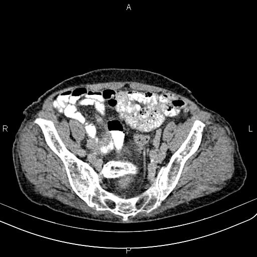 File:Aortic aneurysm and Lemmel syndrome (Radiopaedia 86499-102554 Axial C+ delayed 62).jpg