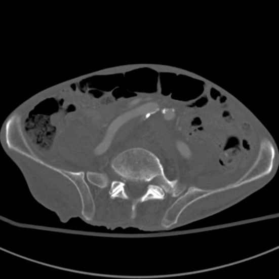Aortic aneurysm with spinal destruction (Radiopaedia 42301-45410 Axial bone window 73).jpg