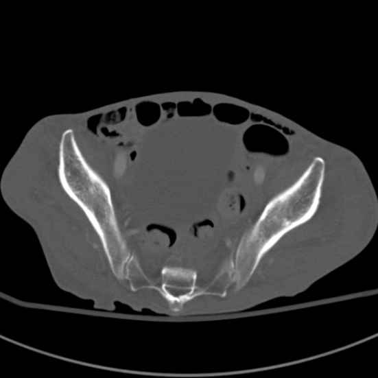 Aortic aneurysm with spinal destruction (Radiopaedia 42301-45410 Axial bone window 91).jpg