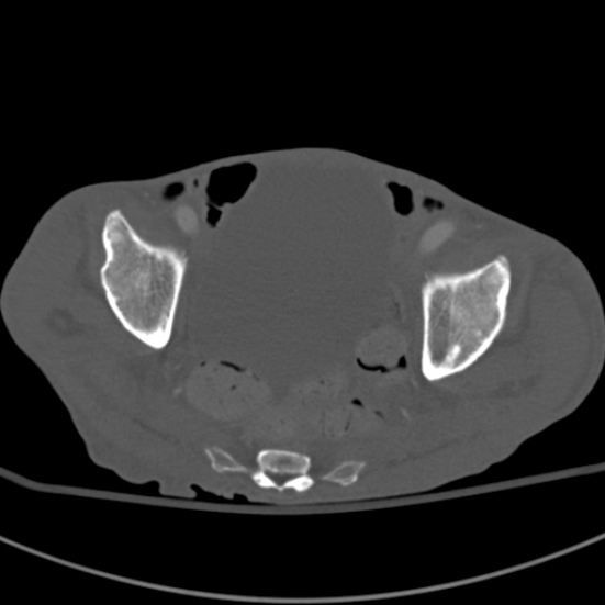 Aortic aneurysm with spinal destruction (Radiopaedia 42301-45410 Axial bone window 96).jpg