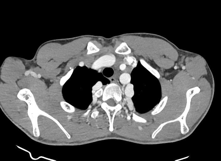 File:Aortic coarctation with aneurysm (Radiopaedia 74818-85828 A 167).jpg