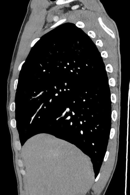 Aortic coarctation with aneurysm (Radiopaedia 74818-85828 B 42).jpg
