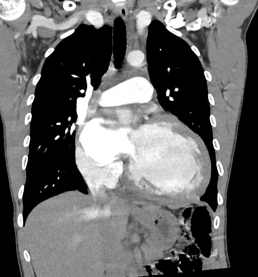 File:Aortic coarctation with aneurysm (Radiopaedia 74818-85828 C 53).jpg