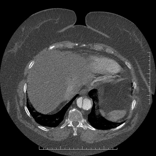 Aortic dissection- Stanford A (Radiopaedia 35729-37268 B 17).jpg
