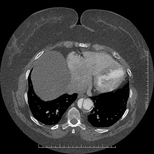 Aortic dissection- Stanford A (Radiopaedia 35729-37268 B 7).jpg