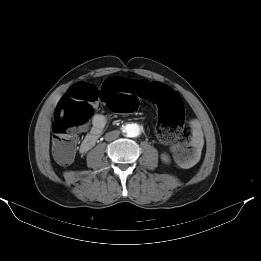 Aortic dissection- Stanford type A (Radiopaedia 22085-22085 A 56).jpg