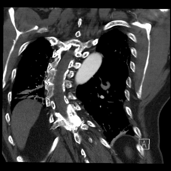 Aortic dissection (CTPA) (Radiopaedia 75506-86750 B 60).jpg