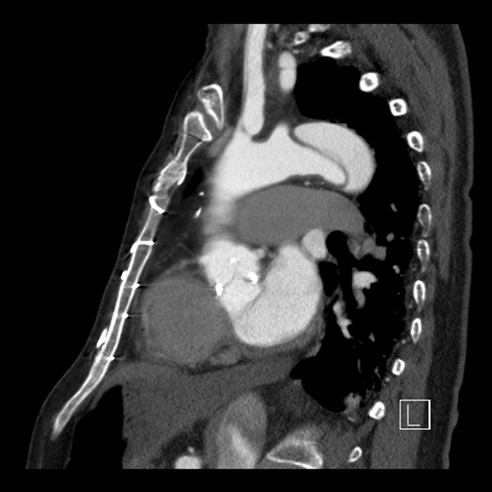 File:Aortic dissection (CTPA) (Radiopaedia 75506-86750 C 64).jpg