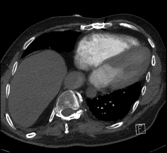 File:Aortic dissection (CTPA) (Radiopaedia 75506-86751 Axial C+ CTPA 101).jpg