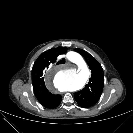 Aortic dissection (Radiopaedia 27466-27665 C+ arterial phase 69).jpg
