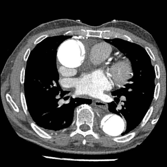 Aortic dissection - DeBakey Type I-Stanford A (Radiopaedia 79863-93115 A 20).jpg