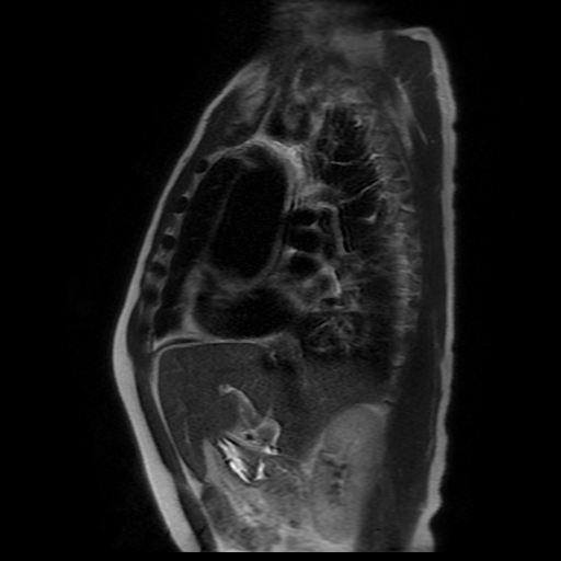 File:Aortic dissection - Stanford A -DeBakey I (Radiopaedia 28339-28586 Sagittal T2 17).jpg