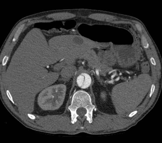Aortic dissection - Stanford type B (Radiopaedia 73648-84437 A 122).jpg