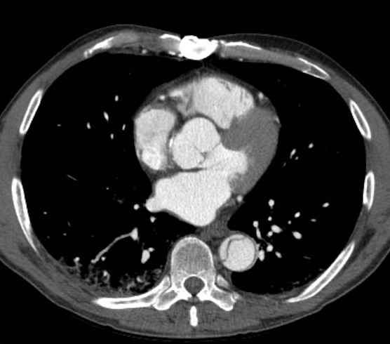 Aortic dissection - Stanford type B (Radiopaedia 73648-84437 A 68).jpg