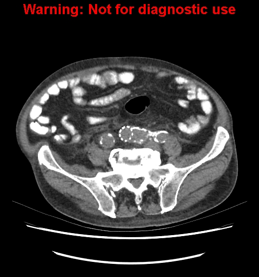 File:Aortic graft infection (Radiopaedia 44979-48907 Axial non-contrast 68).jpg