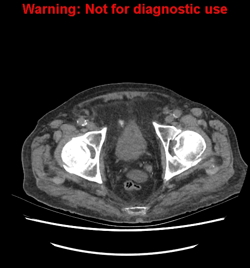 Aortic graft infection (Radiopaedia 44979-48907 Axial non-contrast 87).jpg