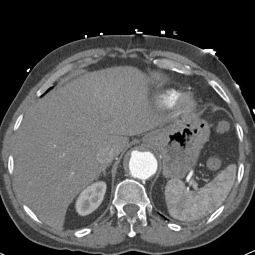 File:Aortic intramural hematoma (Radiopaedia 31139-31838 B 77).jpg