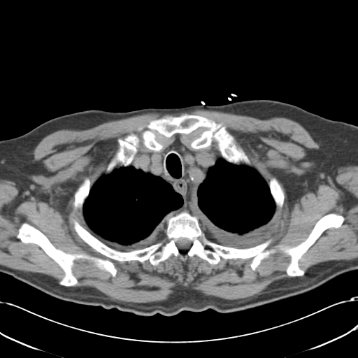 Aortic intramural hematoma (Radiopaedia 34260-35540 Axial non-contrast 10).png