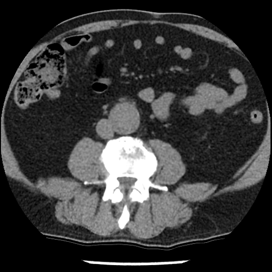 File:Aortic intramural hematoma (type B) (Radiopaedia 79323-92387 Axial non-contrast 79).jpg