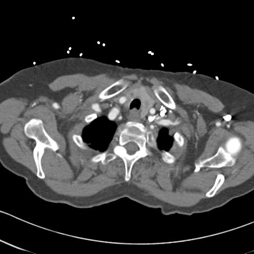 Aortic intramural hematoma from penetrating atherosclerotic ulcer (Radiopaedia 31137-31836 A 5).jpg