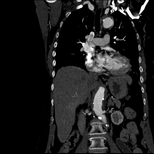 Aortic intramural hematoma from penetrating atherosclerotic ulcer (Radiopaedia 31137-31836 C 31).jpg