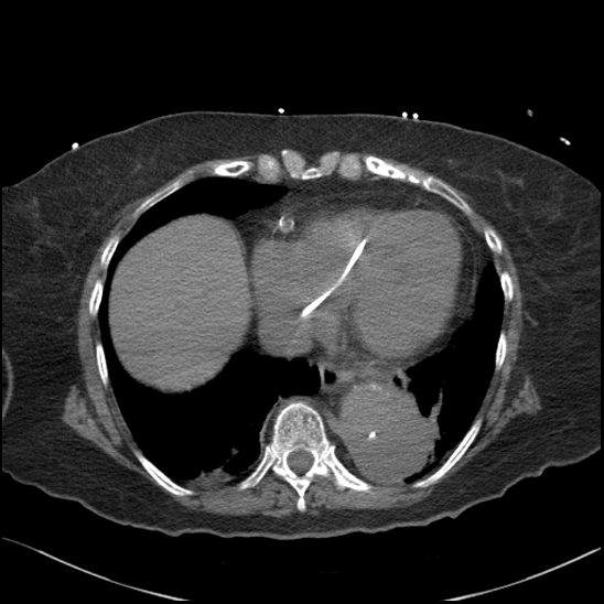 File:Aortic intramural hematoma with dissection and intramural blood pool (Radiopaedia 77373-89491 Axial non-contrast 71).jpg