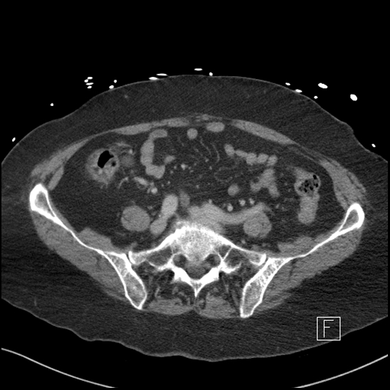 Aortic intramural hematoma with dissection and intramural blood pool (Radiopaedia 77373-89491 E 67).jpg