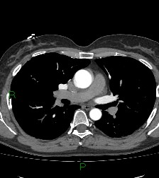 File:Aortic valve endocarditis (Radiopaedia 87209-103485 C 43).jpg