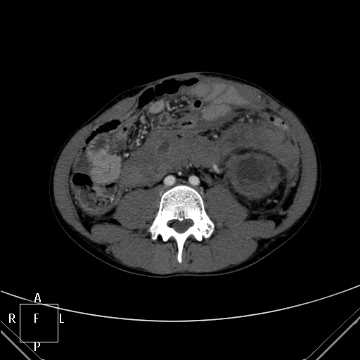File:Aorto-left renal vein fistula (Radiopaedia 45534-49628 A 43).jpg