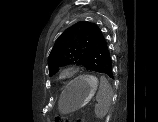 File:Aortoesophageal fistula with endovascular repair (Radiopaedia 73781-84592 Sagittal C+ CTPA 161).jpg