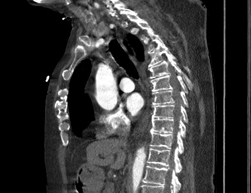 Aortoesophageal fistula with endovascular repair (Radiopaedia 73781-84592 Sagittal C+ CTPA 93).jpg
