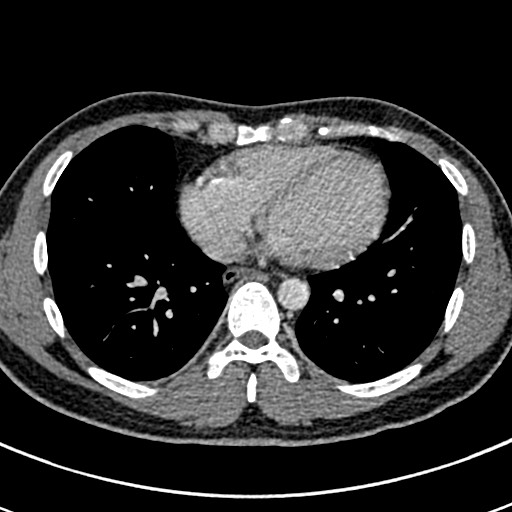 Apical lung mass mimic - neurogenic tumor (Radiopaedia 59918-67521 A 54).jpg
