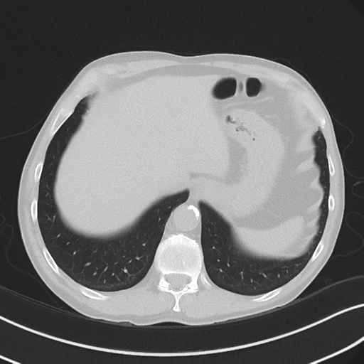 Apical pulmonary metastasis (Radiopaedia 46338-50754 Axial non-contrast 55).png