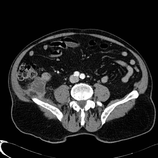 Appendiceal adenocarcinoma complicated by retroperitoneal abscess (Radiopaedia 58007-65039 B 86).jpg