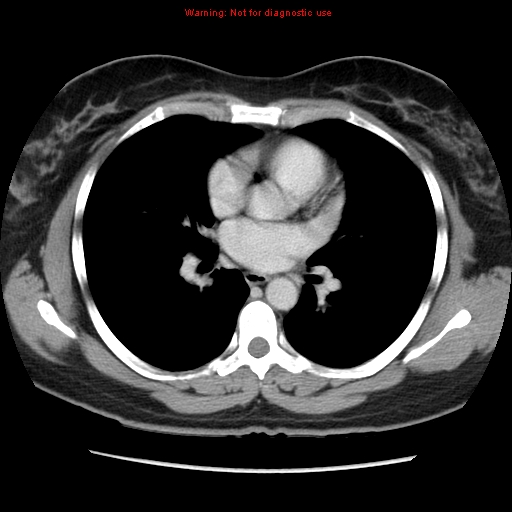 Appendiceal mucinous cystadenoma (Radiopaedia 8263-9111 Axial liver window 3).jpg