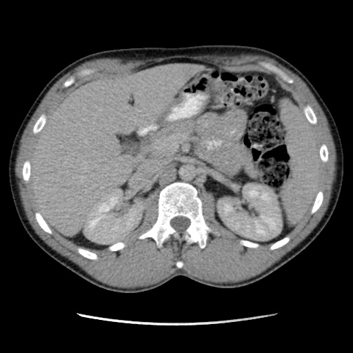 Appendicitis complicated by post-operative collection (Radiopaedia 35595-37113 A 21).jpg
