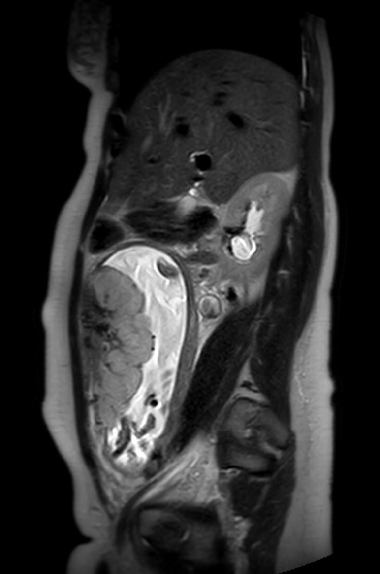 Appendicitis in gravida (MRI) (Radiopaedia 89433-106395 Sagittal T2 43).jpg