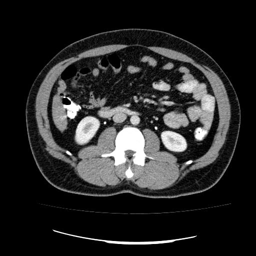 Appendicitis with diverticulosis (Radiopaedia 47693-52383 Axial C+ 67).jpg