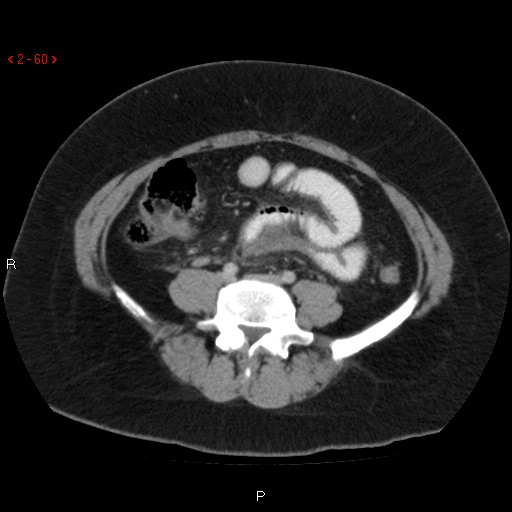 File:Appendicitis with microperforation- promontoric type (Radiopaedia 27268-27442 C 48).jpg